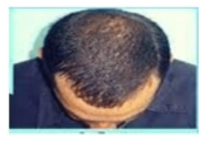 Integrative Treatment For Hair Loss