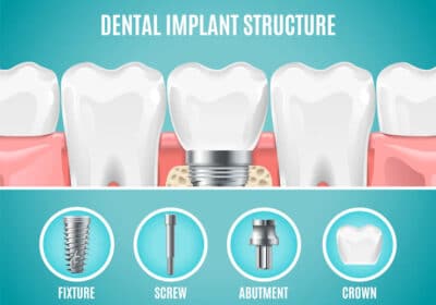 The Best Dentist For Implant Services in South East London | The Mindful Dentist