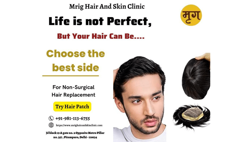 Hair Patch in Just @5999/- in Delhi | Mrig Hair and Skin Clinic - ADPOSTMAN