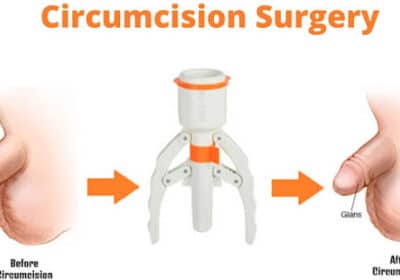 Best ZSR Circumcision Surgery in Ahmedabad, Gujarat | Sadbhavna Hospital