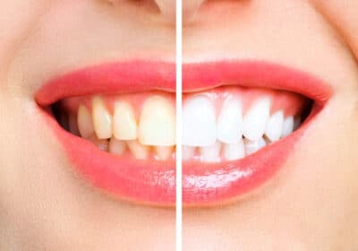 Which Teeth Whitening Service is Right For You ?