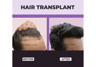 Best Hair Transplant Clinic in Delhi | Chandra Clinic