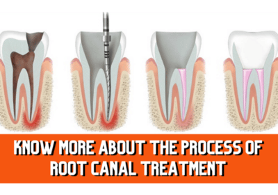 Root-canal-image-1
