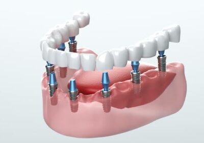 Best Dental Implants in Visakhapatnam