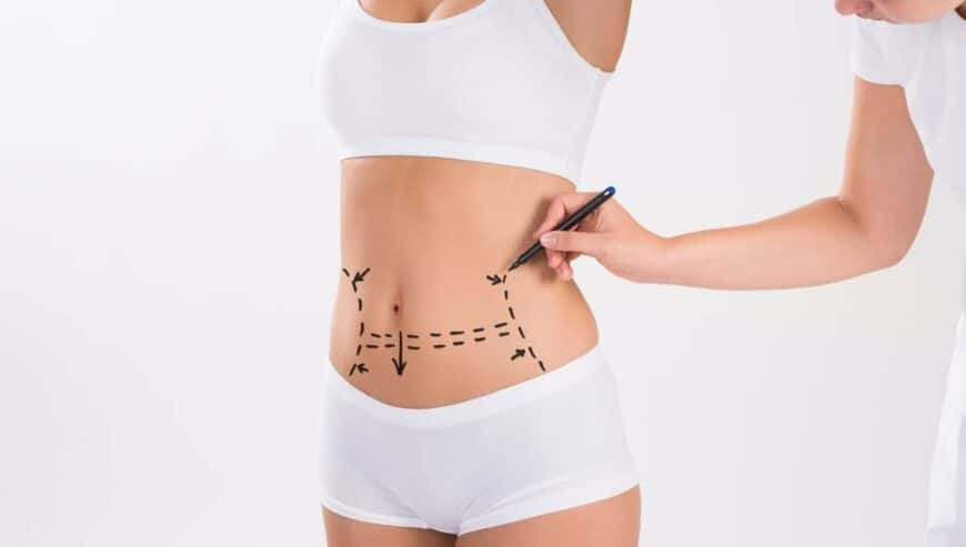 Are You Looking For Liposuction Treatment in Delhi