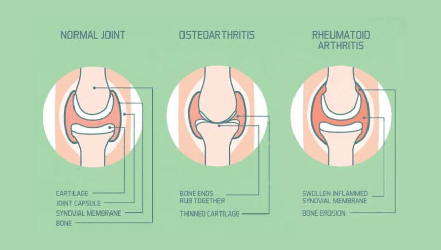 Rheumatoid Arthritis Treatment in Zirakpur | 24/7Homeopathy