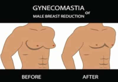 Male Breast Reduction Surgery in Delhi | The Aesculpir