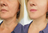 Wholesale Price Anti-Aging 100iu Korea Botox For Wrinkle Removing | Bioderglow.com