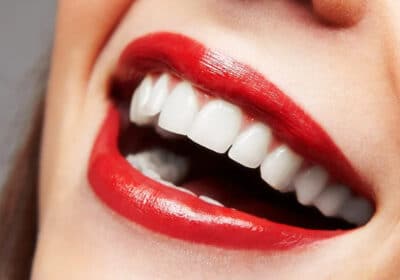 Best Dental Veneers in Delhi | Silver Crest Dental Studio