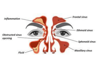 Allergic-Sinusitis-Ayurvedic-Treatment-in-Ludhiana