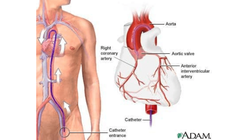 Angiography-in-Pune