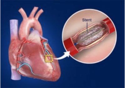 Coronary Angioplasty Treatment in Pune | Hridaymitra Cardia Clinic
