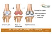 Joint Replacement in Hyderabad | Kasturi Hospital
