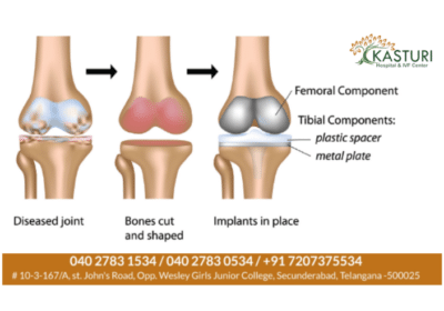 Joint-Replacement-1