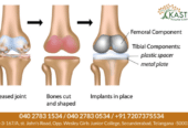 Joint-Replacement