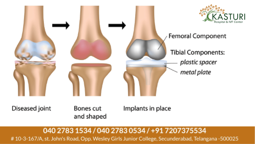 Joint Replacement in Hyderabad | Kasturi Hospital