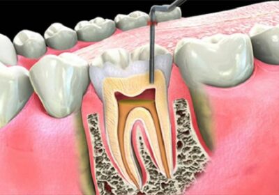 Root-canal-treatment