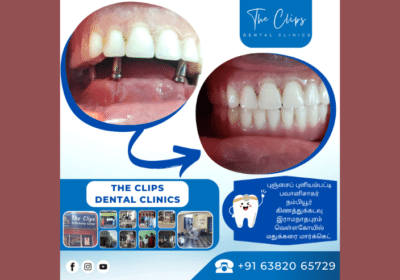 Orthodontic Center in Coimbatore | The Clips