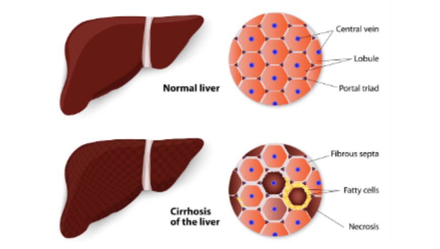 liver-surgery-1