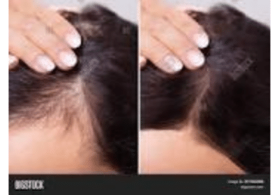 Best Hair Specialist Near Me in Pune | The Daily Aesthetics Clinic