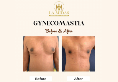 Gynecomastia Surgery in Gurgaon | La Midas