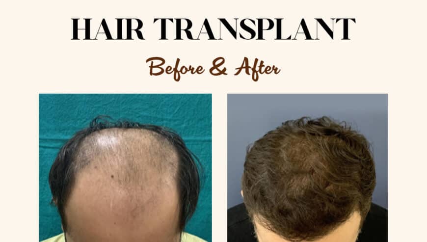 Best Hair Transplant in Gurgaon | La Midas