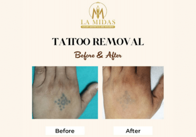 Laser Tattoo Removal in Gurgaon | La Midas Clinic