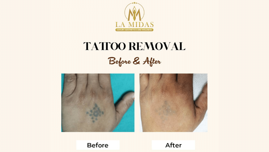 Laser Tattoo Removal in Gurgaon | La Midas Clinic