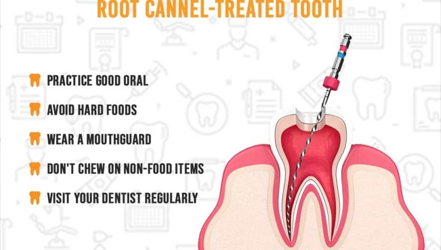 Single Sitting Root Canal Treatment in Hyderabad | Dr. Gowd’s Dental Hospital