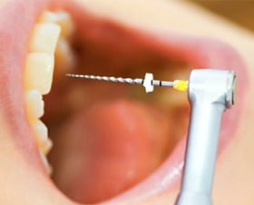 Single Sitting Root Canal Treatment in Hyderabad | Dr. Gowd’s Dental Hospital