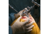 Best Knee Replacement Surgeon in Indore | Dr. Vinay Tantuway