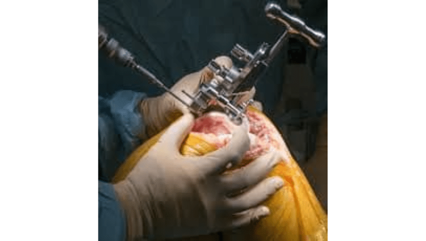 Best Knee Replacement Surgeon in Indore | Dr. Vinay Tantuway