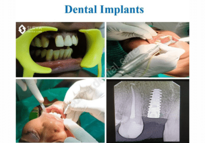 Dental Braces in Trichy | Surya Dental Care