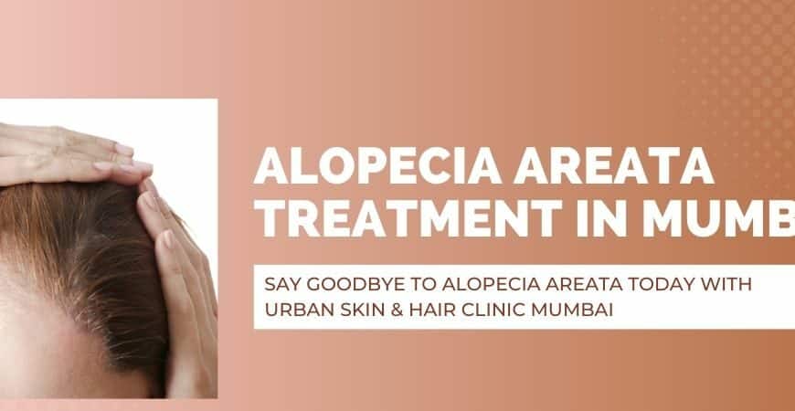 Alopecia Areata Treatment in Andheri West Mumbai | USHC