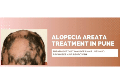 Alopecia Areata Treatment in Pune by Dr. Kiran