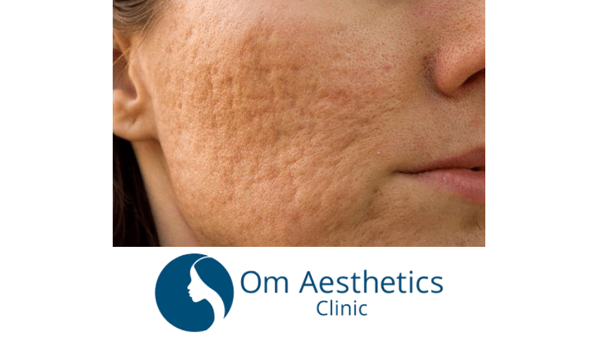 Smooth Your Skin: Pitted Scars Treatment in Singapore | Om Aesthetics