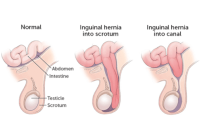Paediatric Hernia Surgery in Lahore | Dr. Muhammad Mohsin