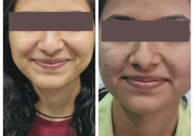 Skin Polishing Treatment in Pune Pimpri Chinchwad | Skin Polishing Treatment Hinjewadi | Glamelite24 Aesthetic Clinic