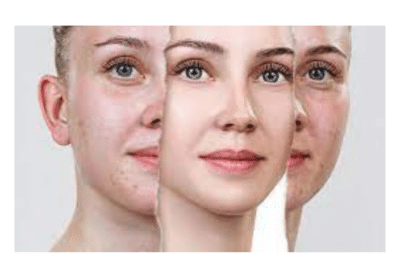 Plastic Surgery For Acne Scars in Noida | The Skin Smiths Clinic