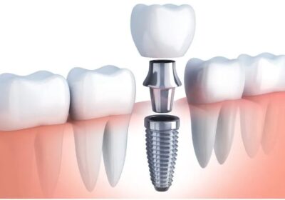 Exceptional Dental Implants in Jaipur | The ARC Dental Clinic