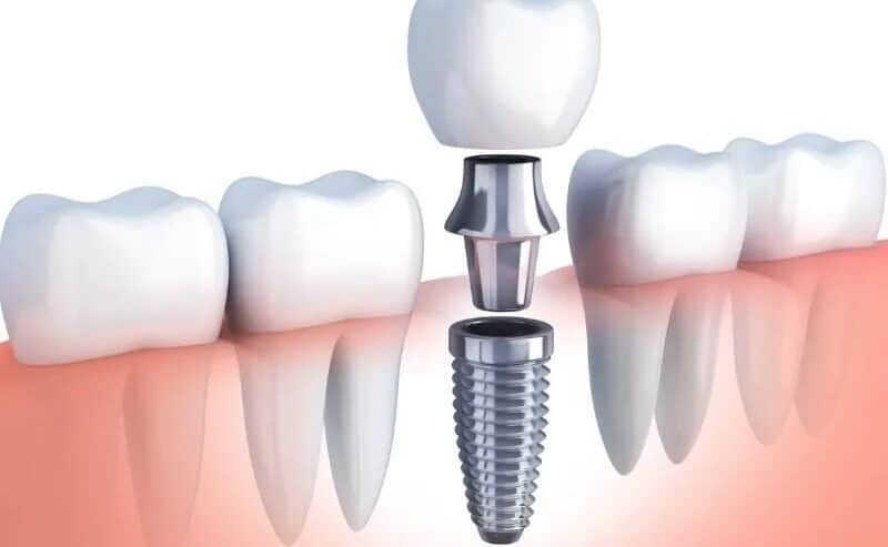 Exceptional Dental Implants in Jaipur | The ARC Dental Clinic