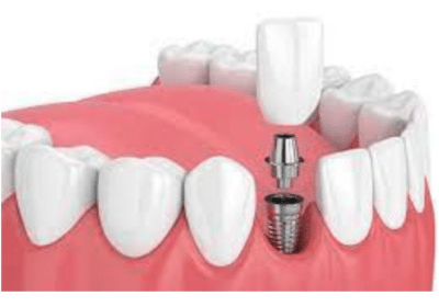 Best Dental Implant Services in Jaipur | The ARC Dental Clinic