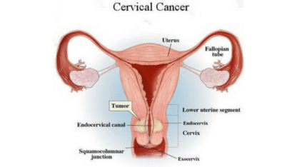 Find Trusted Cervical Cancer Treatment Hospital in Hyderabad | AMVI Hospital