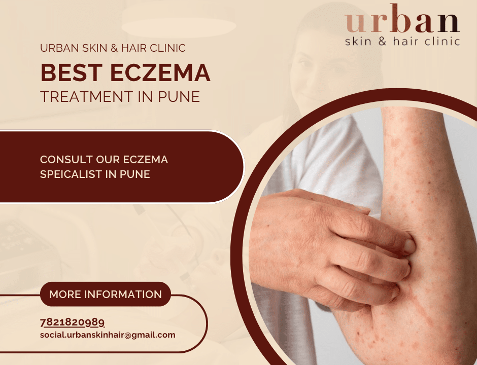 Effective Eczema Treatment in Pune | Urban Skin and Hair Clinic