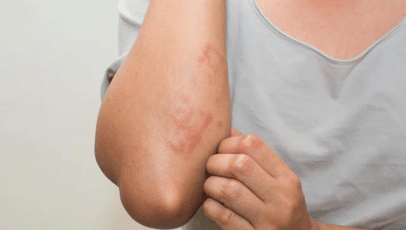Fungal Infection Treatment in Noida | Skin Smiths Clinic