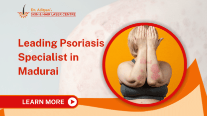 Leading Psoriasis Specialist in Madurai | Adityan Skin and Hair Laser Centre