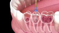 Find The Perfect Root Canal Treatment in Jaipur | NV Aesthetics and Dental Hub