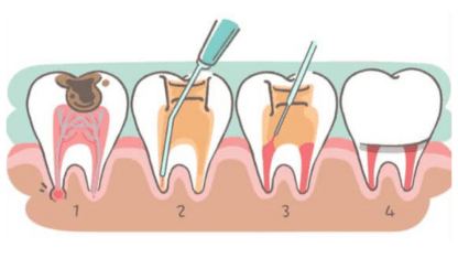 Best-Root-Canal-Treatment-in-Jaipur-NV-Aesthetics-and-Dental-Hub