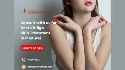 Best-Vitiligo-Skin-Treatment-in-Madurai-Adityan-Skin-and-Hair-Laser-Centre