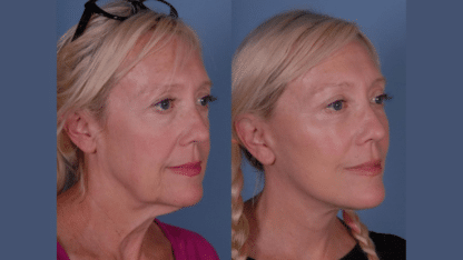 Facelift-Surgery-Cost-in-Lahore-Cosmetico-Plasty